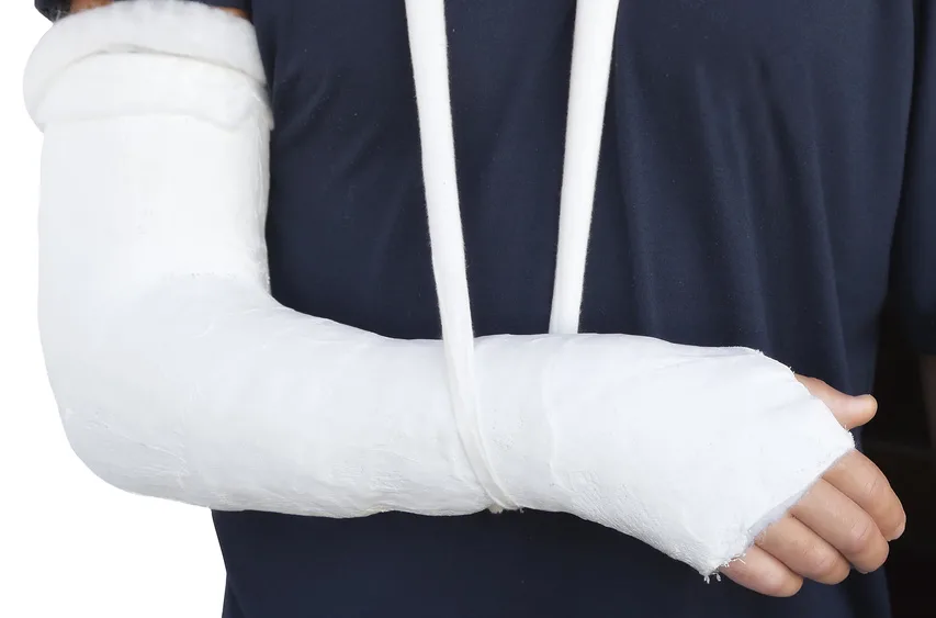 Bras dans le plâtre, soutenu par une écharpe blanche, pour l'accident du travail